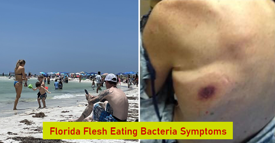Florida Flesh Eating Bacteria Symptoms