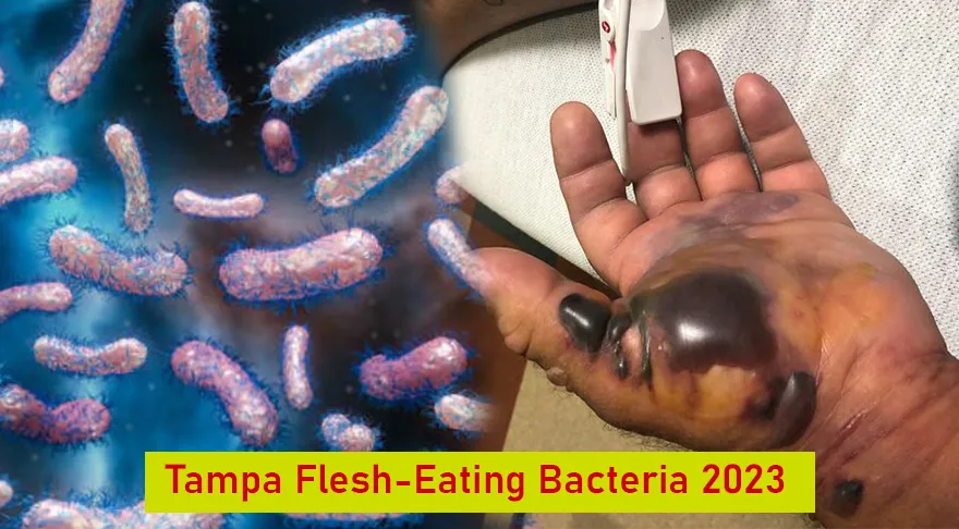 Tampa Flesh-Eating Bacteria 2023